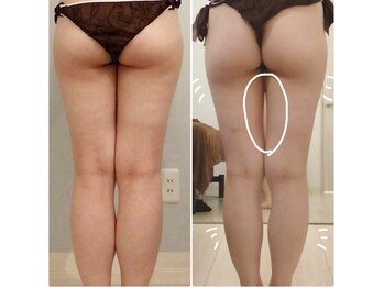 カリーナ(Carina)の写真/落としにくい下半身にお悩みの方必見☆セルライトケア&小尻&ヒップアップ＆外、前ハリケア！