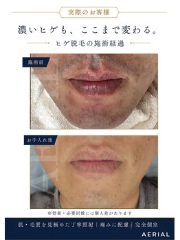 エアリアル 中津店/ヒゲ脱毛ビフォーアフター