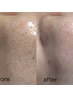 【毛穴汚れざらつき】贅沢美容液毛穴洗浄+毛穴引き締め肌活性炭酸パック