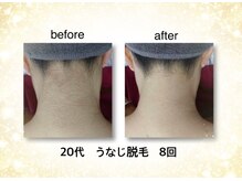 KMB 恵比寿店/NPL脱毛　うなじ　8回