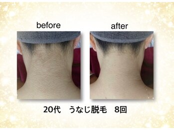 KMB 恵比寿店/NPL脱毛 うなじ 8回