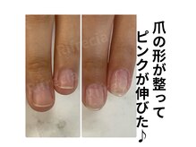 縦長の爪を目指せます！薄くなってしまった爪でお悩みの方にも◎