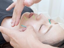 はぴねす鍼灸整骨院 西宮院/美容鍼