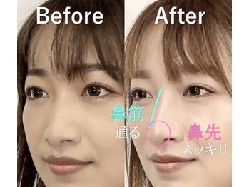 ラプリ 大宮店(Raplit)/隆鼻＋輪郭矯正40分10回