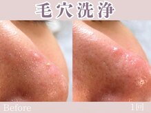 レッド(RED)/毛穴洗浄