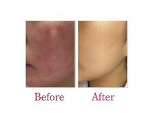サロン ド グランツィア(salon de Granzia)の雰囲気（しつこい肌荒れも撃退◎肌質改善でお肌の内側からツヤツヤ陶器肌）