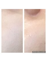 サロン ディ レアーレ(SALON DI REALE)/肌のキメがとても変化！！