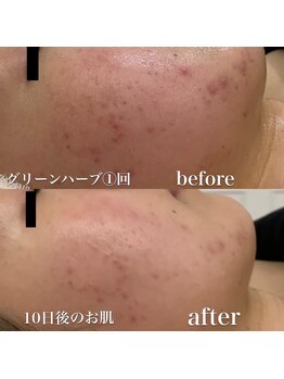 ルリミ(Relimi)/ハーブピーリング　Before After