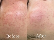 シーベル 小倉/症例写真/ハーブピーリング