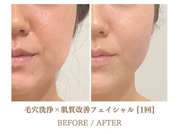 フルハウス エアリアル(Full House AeriAl)/毛穴洗浄×小顔フェイシャル