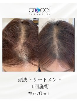 ユミト(Umit)/プロセルスカルプ