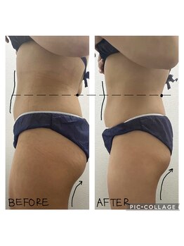 エンチャント(ENCHANT)/痩身超音波リフトでサイズダウン