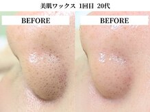 サンビ(SANBI)/産毛邪魔しているかも！？