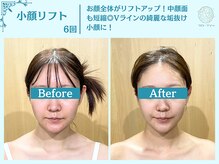 【一回り小顔に】究極小顔コースの施術について[小顔/痩身/毛穴/ブライダル/フェイシャル/毛穴洗浄/たるみ]