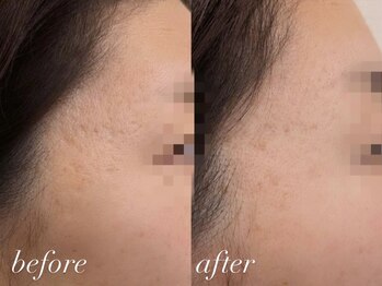 ビューティーサロン プティ(beauty salon petite)/ハーブピーリング/施術1回