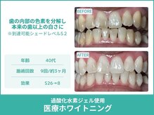 クレア(Crea)/【歯のホワイトニング症例写真】