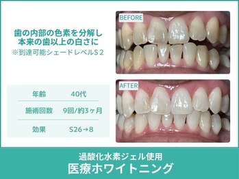 クレア(Crea)/【歯のホワイトニング症例写真】