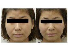 かとう鍼灸整骨院/◆４０代女性　１回の施術例