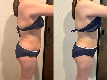 エミナル(Eminal)/◆脂肪冷却　お腹+腰　1回