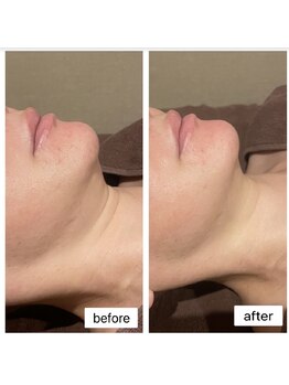 ロージースマイル(Rosy smile)/【韓国脂肪ケア LEMON BOTTLE】