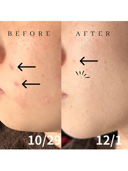 ルルマル(lulumalu)/リアボーテ　シェリースキン使用