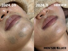 ルーチェの雰囲気（3回照射でこの効果！2週間後にポロポロと毛が落ちてくる！）