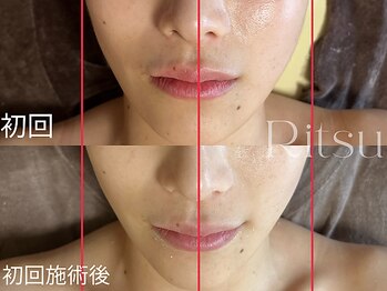 リツ(Ritsu)/リフトアップ/左右差改善