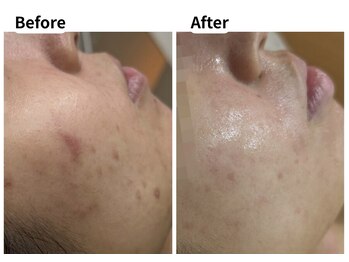 ムーロ バイ ミュー(muro. by mieux)/ハーブピーリング