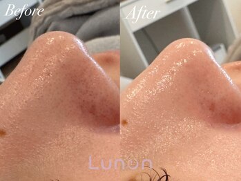 ルノン(Lunon)/毛穴洗浄ハイドロ×ララピール