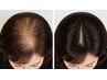 《抜毛》白髪や薄髪！症例多数！早く解決したい悩みだから本気ケア！【全頭】