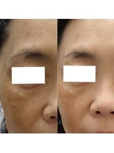 ル ボヌール&nbsp;美容液導入 ボヤシミ♪