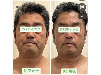 アバティック(ABatick)/小顔コルギの効果