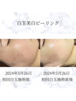 サロン ド メデューズ 札幌店(Salon de meduse)の写真/すみを解消してパッと明るい表情へ◇本格ピーリングと肌管理で、透き通るような白玉美肌に！