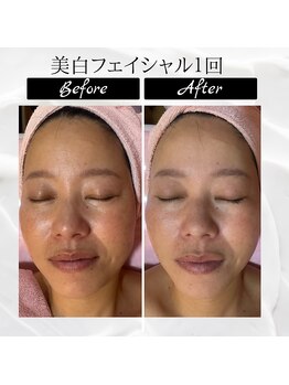 ポムポムボナー/ハリ/毛穴/小顔/美白同時改善♪