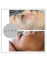 ウララ(ulala)/シミケアビフォーアフター