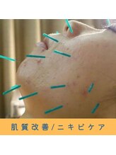 いつつのき/美容鍼