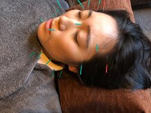 レメディ/美容鍼コース