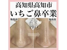 エクラーレ(Eclale)/【毛穴ケア】症例