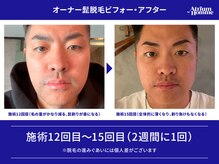 アトリウム オム 恵比寿店(ATRIUM HOMME)/ひげ脱毛ビフォーアフター