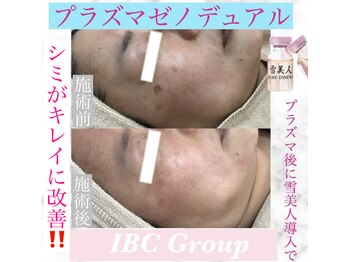 トータルサロンアイビーシー(トータルサロンIBC)/プラズマゼノデュアルでシミ改善