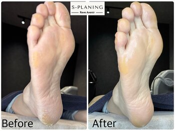 レーヴ アヴニール(Reve Avenir)/S-PLANING韓国式足裏角質ケア