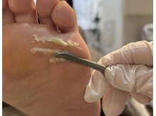 韓国式足裏ケア｢ペディプランニング｣劇的変化で赤ちゃん踵に♪