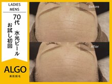 アルゴ 小松店(ALGO)/水光ピール（70代女性）