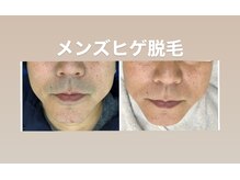 ベラドンナ(Bella Donna)/人気のメンズ脱毛☆