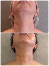 アリィ(Alii)/顎のもたつき、首のたるみ