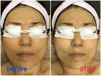 アイル イオン喜連瓜破駅前店/【顔脱毛】結果