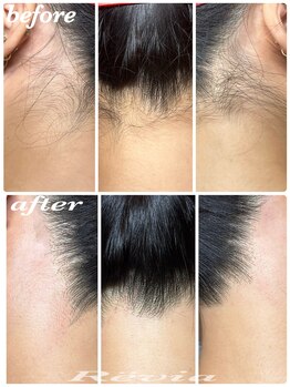 レビア(Revia)/うなじ脱毛【WAX】before→after