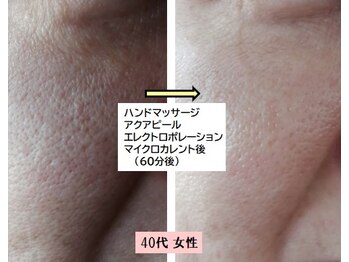 美肌プロジェクト カーラ 東川口店(CARA)/ハイドラフェイシャル◆40代