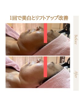 ポムポムボナー/ハリ/毛穴/小顔/美白同時改善♪