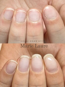 マリーロール 梅田店(Marie Laure)/自爪育成/深爪矯正/ネイルケア